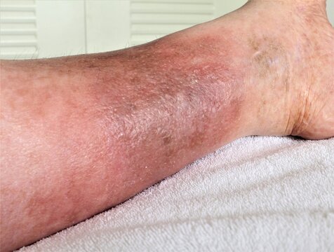A woman's leg is shown, she is suffering from Chronic Venous Insufficiency with mild cellulitis in her legs. In bed as she rest to relieve heaviness, swelling, pain  redness in the leg. 