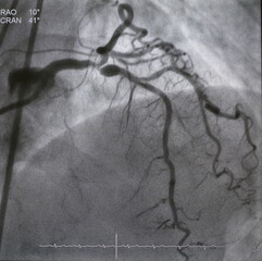Coronary angiogram (CAG) was performed left coronary artery (LCA) stenosis with aneurysm at...