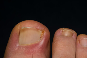 close-up photo of a toenail infection in human	