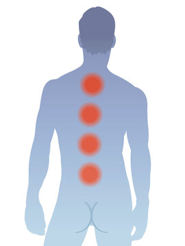 Illustration Shows The Main Areas Of Pain On The Back Caused By Multiple Myeloma