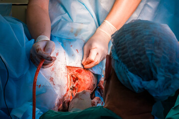 Surgeons use medical instruments to suture human skin during proctological minimally invasive...