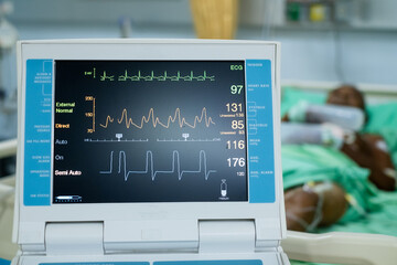 EKG monitor in intra aortic balloon pump machine. Medical equipment in hospital. Medical Technology...