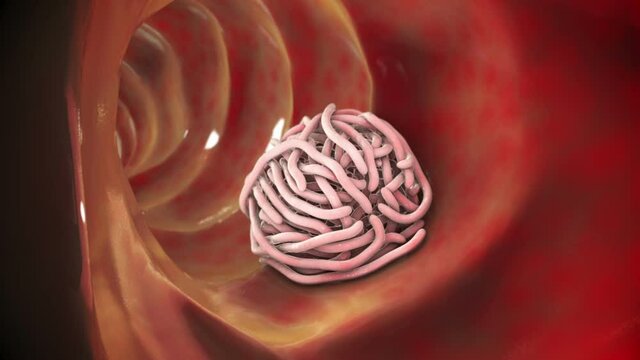 Parasitic worms in the intestinal lumen, 3D animation. Growth and multiplication of nematode worms invading human intestine