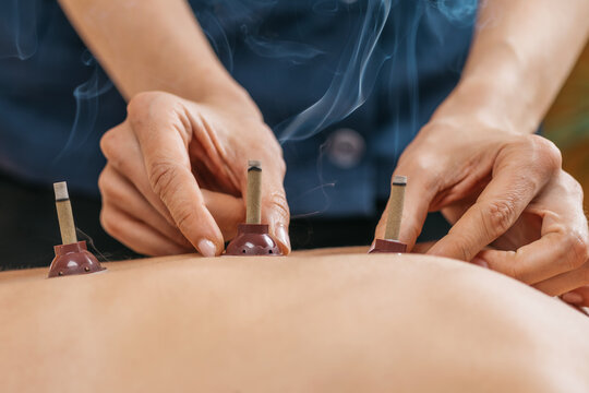 Moxibustion Therapy &ndash; Traditional Chinese Medicine