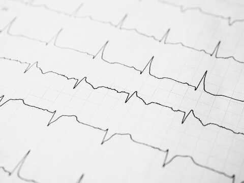 Close up of an electrocardiogram in paper form. ECG or EKG record paper. The heartbeat is shown on the graph. Medical and healthcare concept. Minimalism style template for medical blog. Soft focus