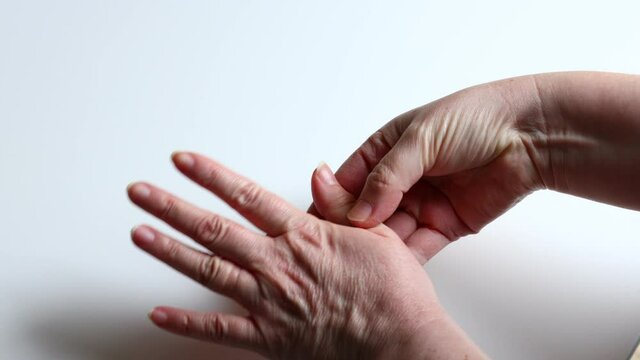 The woman watches and scratches itchy hands, suffering from severe eczema, Atopic dermatitis. red with chapped skin
