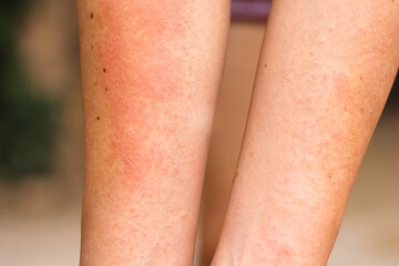 Asian woman has red rash on her arm