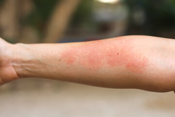 Asian woman has red rash on her right arm