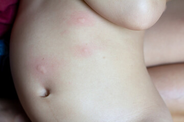 baby with gluten allergy choosing gluten free In wheat flour bread, skin rash in a baby with Nonceliac Gluten.