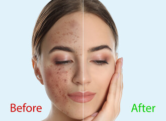 Young woman before and after cosmetic procedure on light background