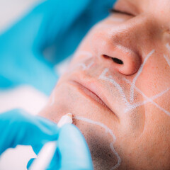 Naklejka premium Dermal Fillers for Men. Marking Man’s Face Before Dermal Filler Treatment