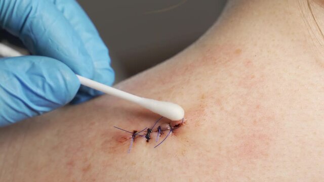 Close-up, a doctor in medical sterile gloves cotton swab treated with antiseptic bleeding wound on the shoulder of a teenage girl.