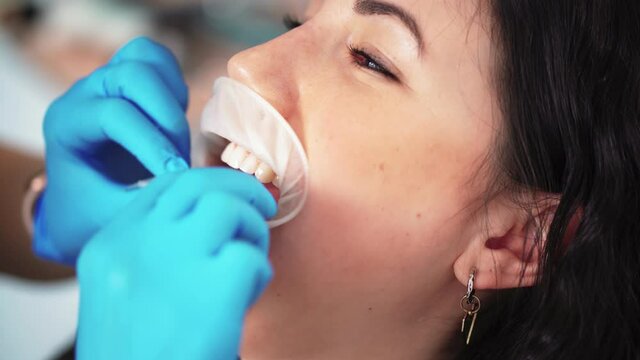 Close-up of a professional dentist placing a special mouth guard in a woman's mouth at a dental clinic. Working process in dentistry. Healthcare and medicine concept.