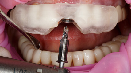 dental template for central tooth implantation and bone milling cutter