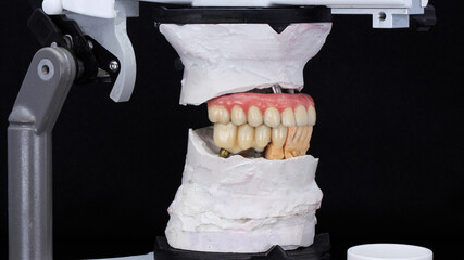 upper jaw prosthesis with pink gum and ceramic crowns on models in the articulator on a black background © Dental Pro Content
