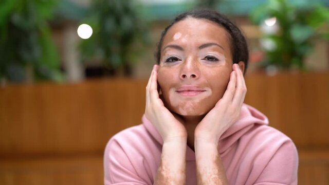 Black African American woman with vitiligo pigmentation skin problem indoor dressed pink hoodie covered her face with her hands Smiling beautiful female Diversity Body positive Acceptance concept 