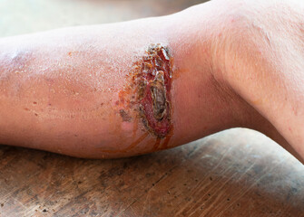 Skin lesions with inflammation of the infected wound