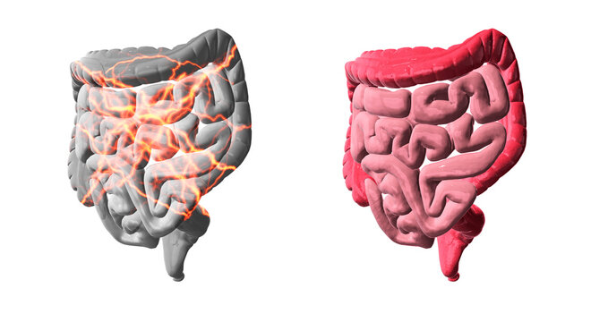 Abdominal pain causing stomach ache, the lightning strokes are visualizing the stabbing pain. On the right the small and large intestine without pain, 3d illustration