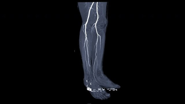 CTA Leg or CT angiography of the leg turn around on the screen for detect peripheral arterial disease.