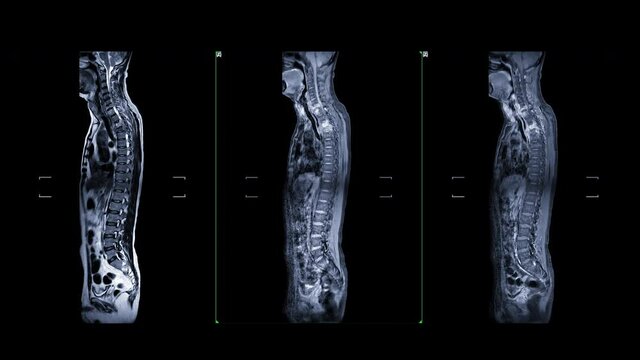 MRI Screening whole spine  with gadolonium contrast showing  spine compress spinal cord .