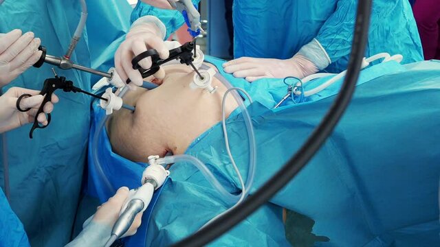 The hands of surgeons in latex gloves and blue uniforms hold special medical instruments during laparoscopic minimally invasive surgery. Treatment of proctological diseases.