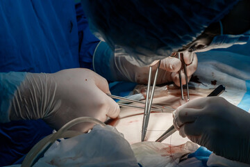 Doctors use medical instruments and metal thread to suture human skin during minimally invasive surgery. Close-up of hands in sterile gloves, covered with blood. Blue uniform and medical masks.