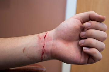 Close up of a cut on a person's wrist 