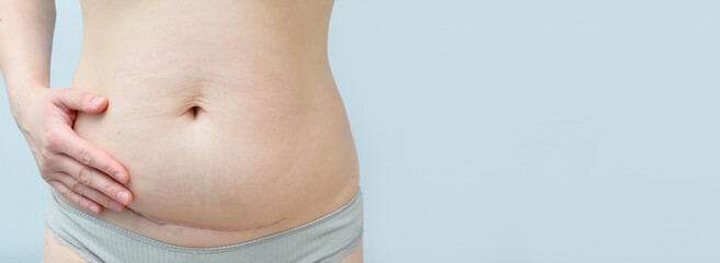 Closeup of woman belly with a scar from a cesarean section on blue background. - obrazy, fototapety, plakaty