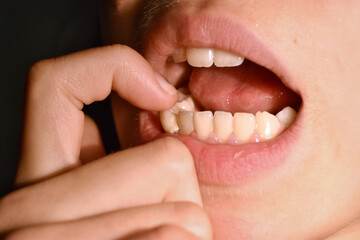 Child mouth wobbling milk teeth