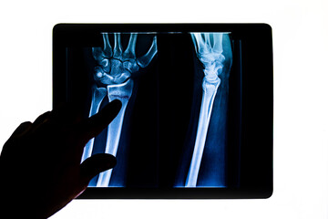 Doctor checking radiography examining x-ray film of patient's arm pointing to radius fracture. X-rayed human hand. X-ray of hand bones. Medical technology radiography.