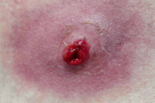 Large furuncle crater with pus.