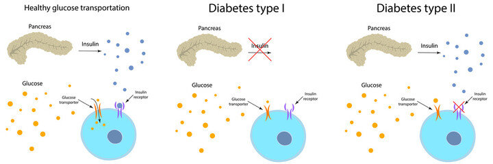 Diabetes type 2, 1, healthy transportation comparison. Pancreas, insulin receptor, glucose transporter, cell.