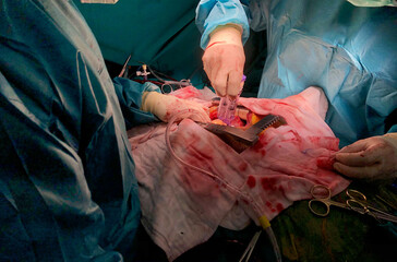 Surgeon was used surgical sealant in open heart surgery.