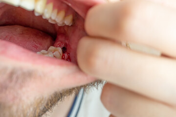 Close-up of a tooth gap in a male mouth for a dental implant with fresh open wound and blood,...