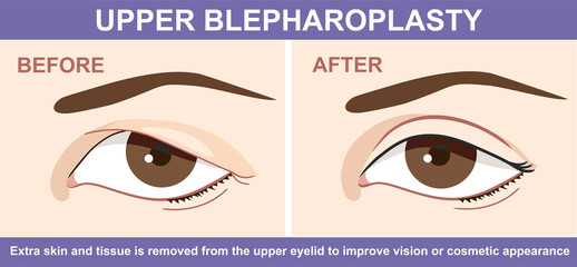 Blepharoplasty of eyelid , before and after. Vector illustration with double eyelid surgery. Infographics with icons of plastic surgery procedures. - obrazy, fototapety, plakaty