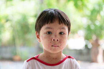 Portrait of sick little  boy. Varicella virus or Chickenpox bubble rash on child