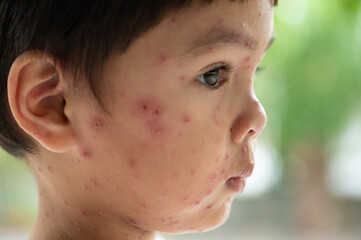 Portrait of sick little  boy. Varicella virus or Chickenpox bubble rash on child