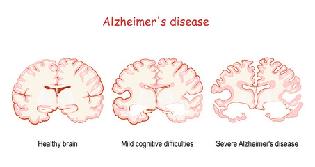 Alzheimer
