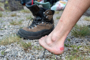 Hiker got a blister on his foot by trekking shoes.