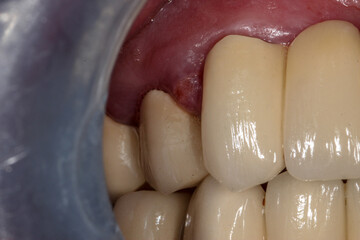 A very bad case of periodontitis