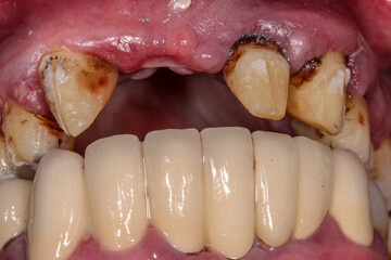 A very bad case of periodontitis