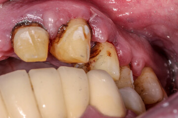 A very bad case of periodontitis