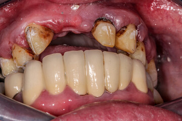 A very bad case of periodontitis