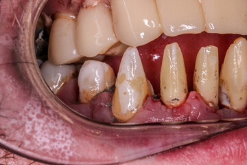 A very bad case of periodontitis
