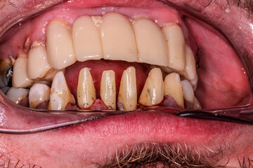 A very bad case of periodontitis