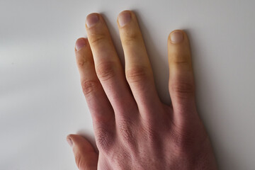 white fingers from the cold, poor blood circulation,close up