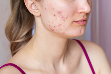 Cropped shot of a young woman's face with the problem of acne. Pimples, red scars on the cheeks and...