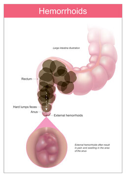 Hemorrhoids. illustration explain cause of haemorrhoids your anus. Healthcare medical infographic..