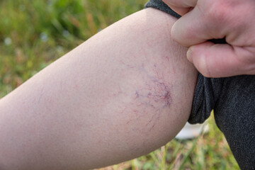 Woman's leg with a lot of broken capillaries on the calf muscle.