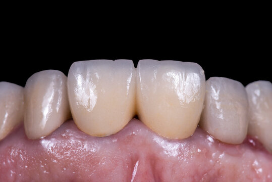 two units pfm crowns